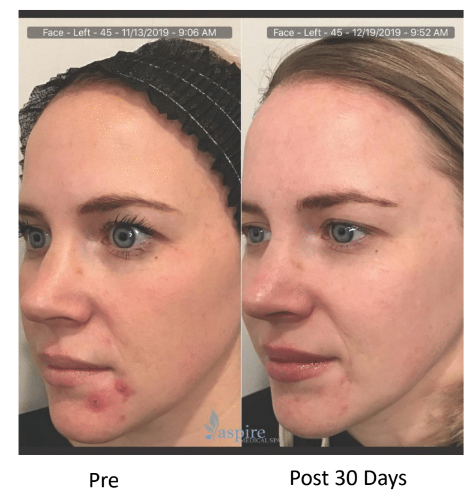 A before and after photo of a woman 's face with acne.