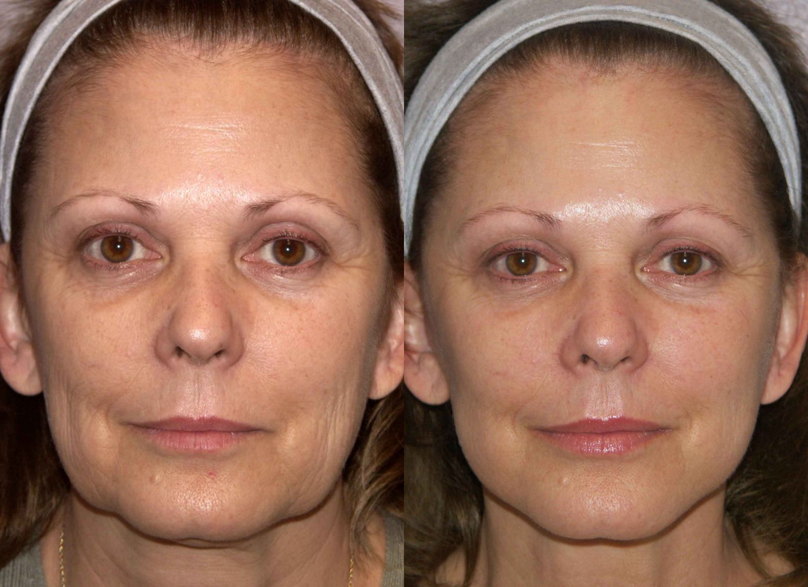 Vampira Face Lift using PrP