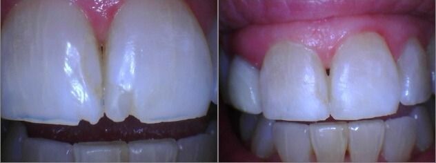 Before and after dental bonding on chipped upper front teeth by Dr. Cocozzo in Malta, NY