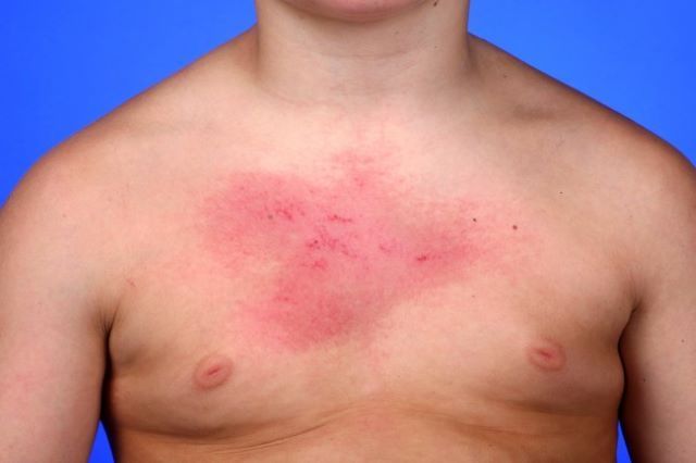 DERMATOMIOSITE