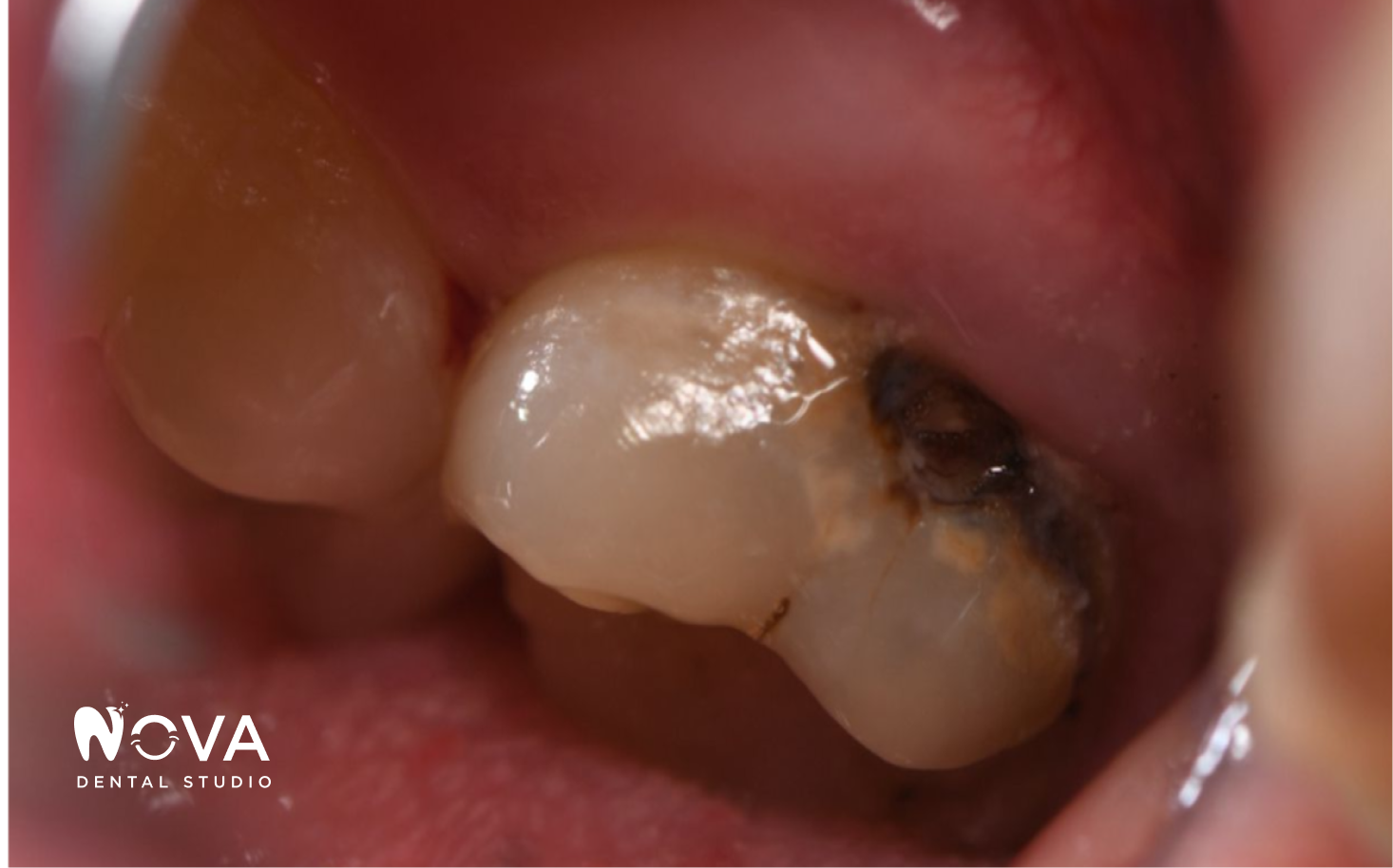 A close up of a person 's mouth with white teeth.