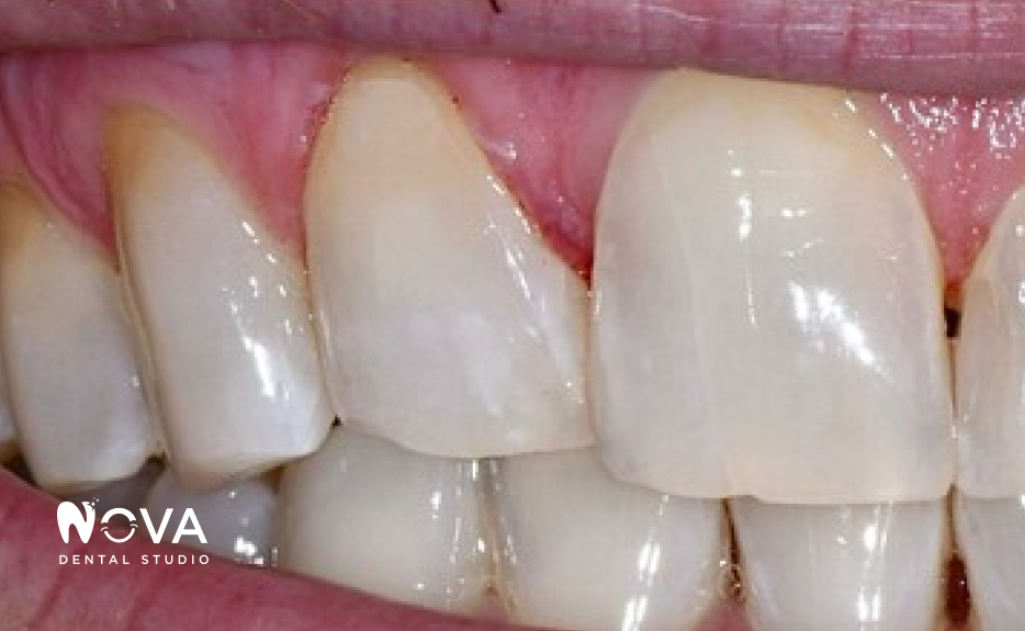 A close up of a woman 's smile with white teeth.