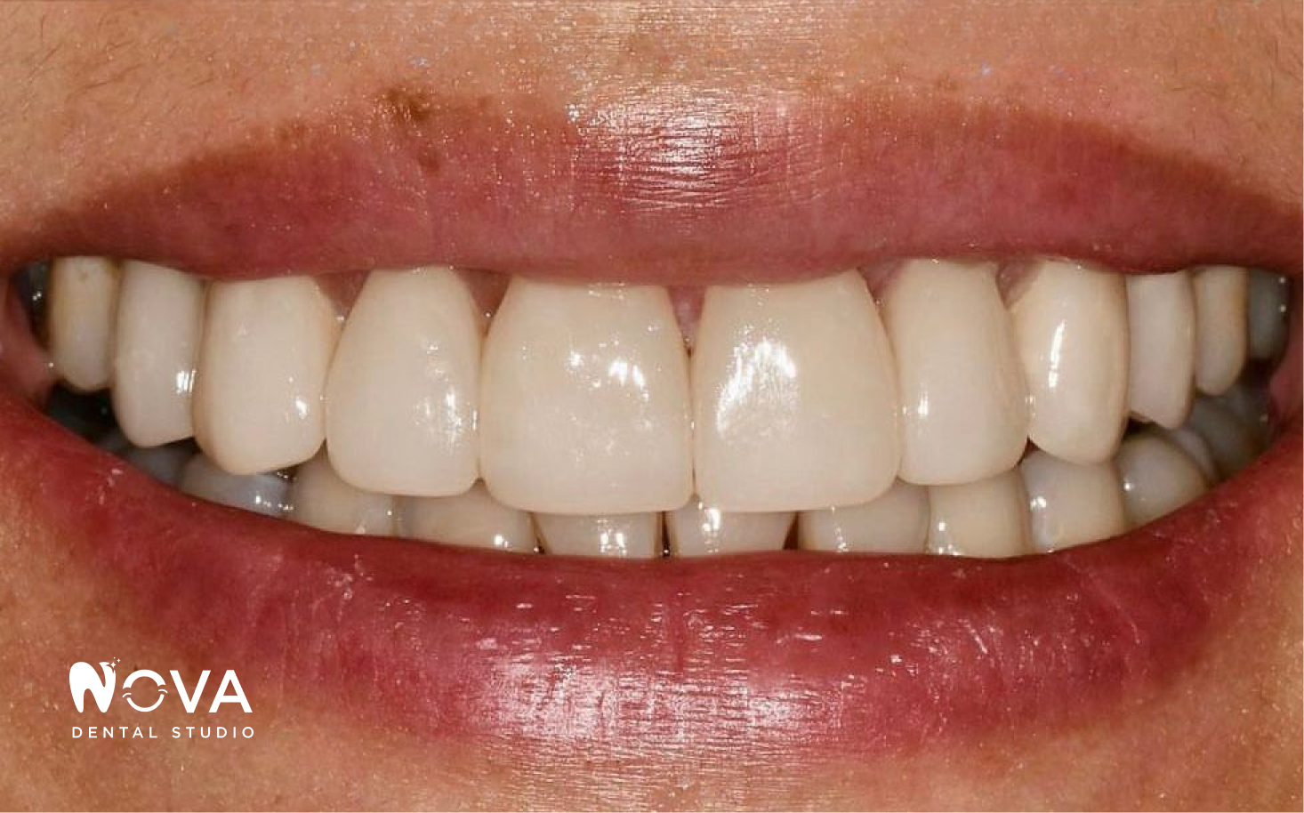 A close up of a woman 's smile with white teeth.