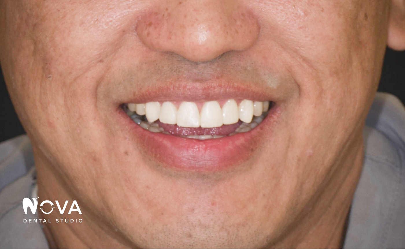 A close up of a person 's teeth with white teeth.