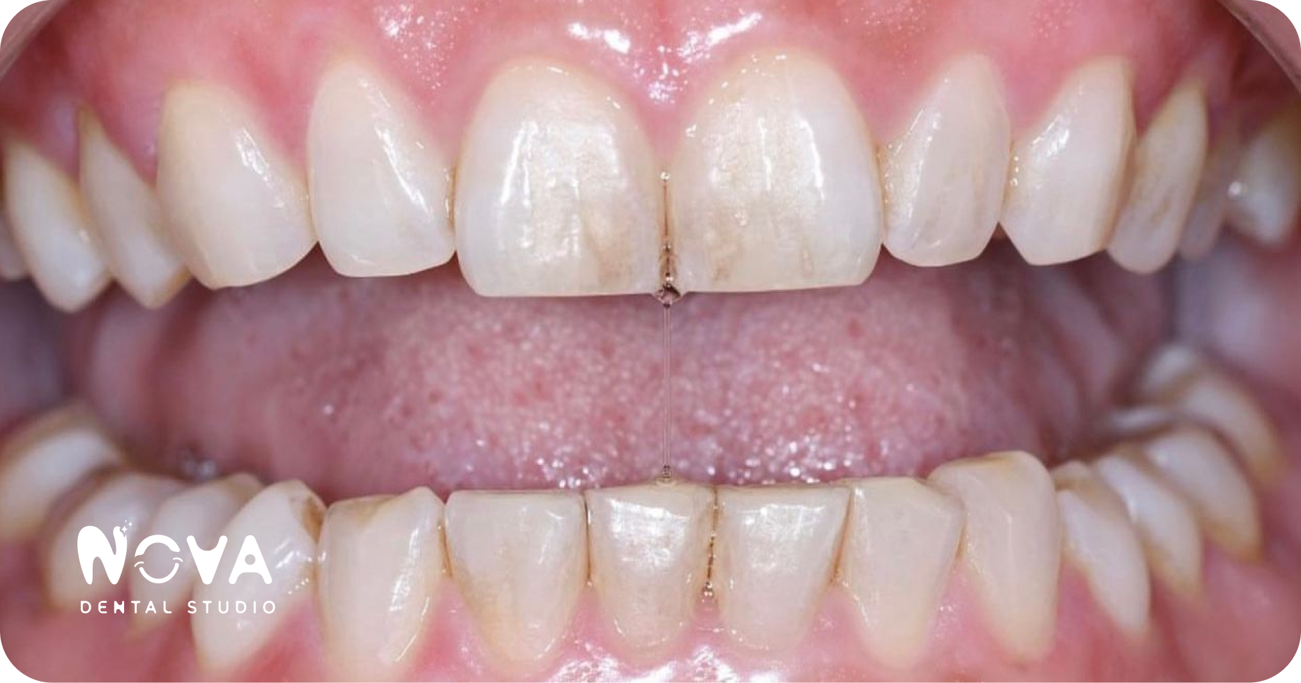 A close up of a person 's teeth and mouth.
