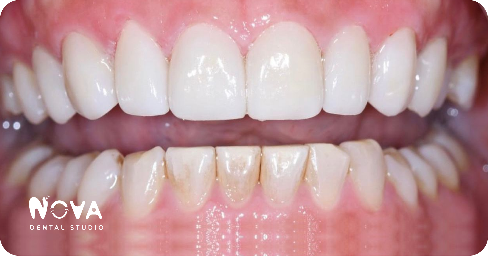 A close up of a person 's teeth with white teeth.