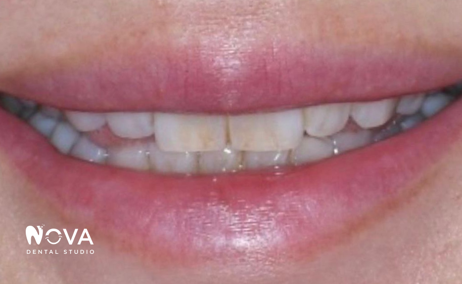 A close up of a person 's mouth with white teeth.