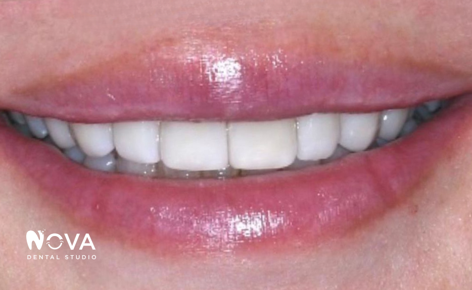 A close up of a woman 's smile with white teeth.