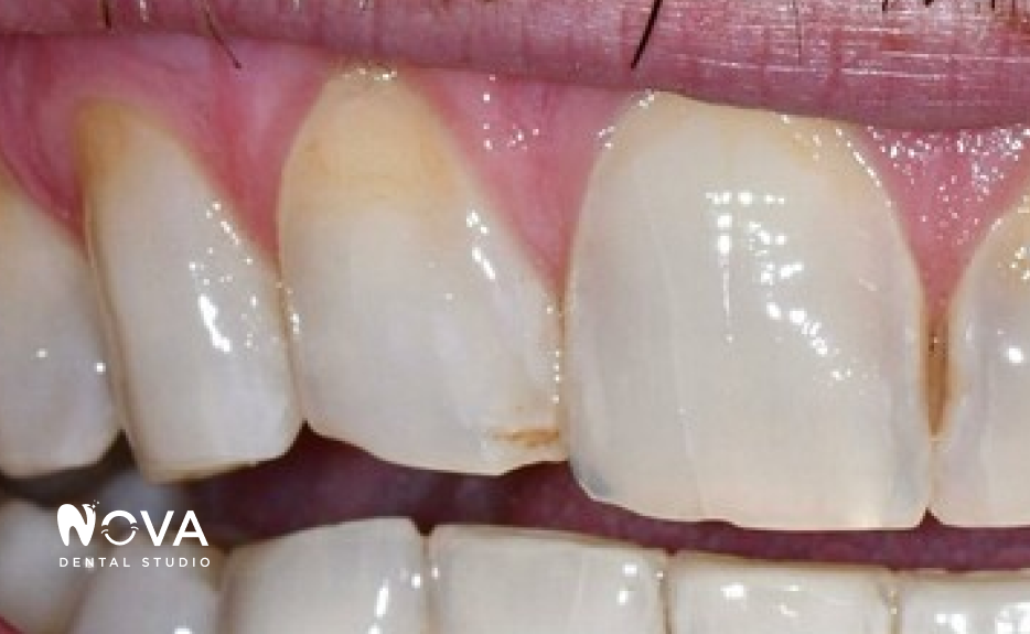 A close up of a woman 's mouth with white teeth and red lips.