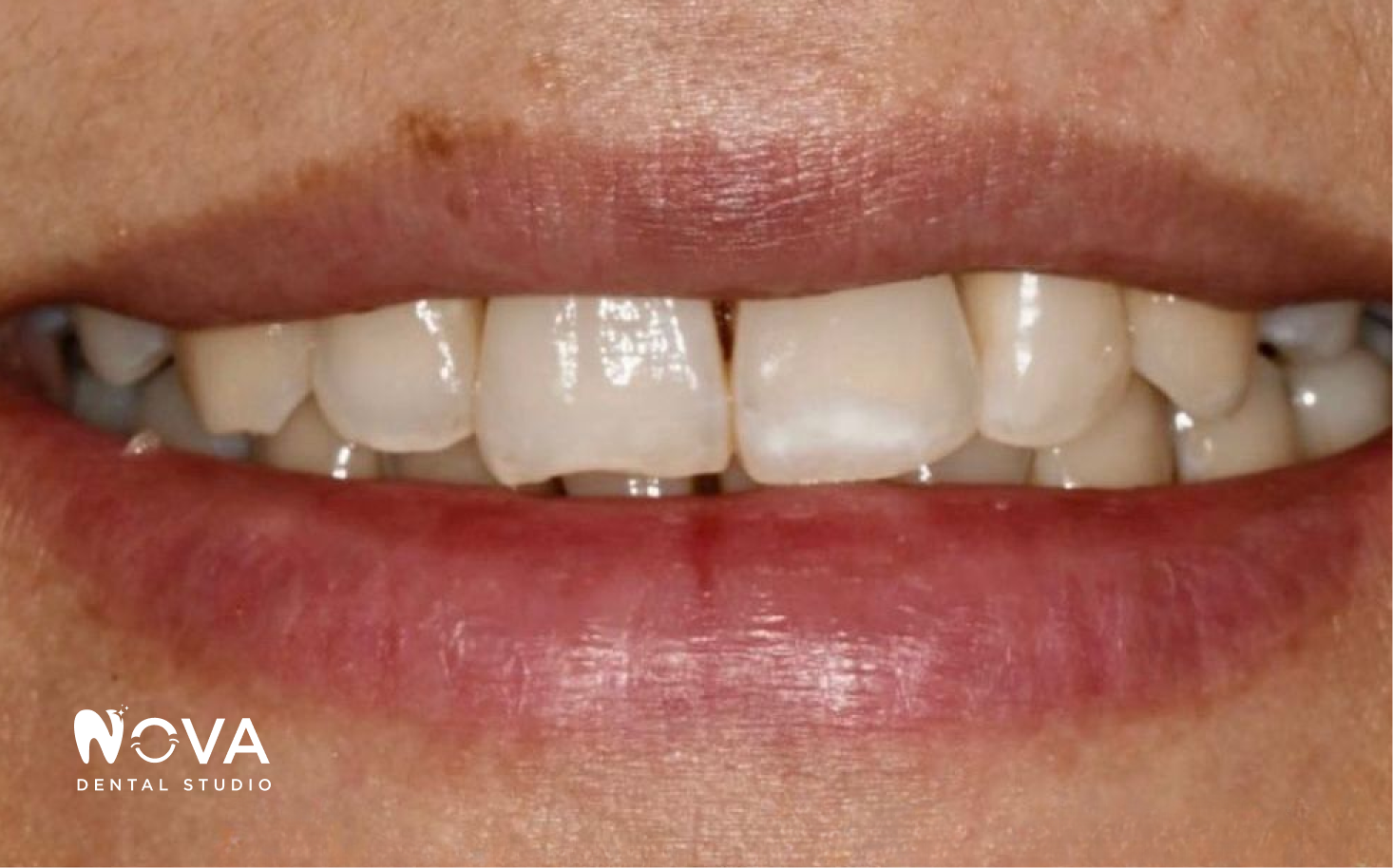 A close up of a woman 's mouth with white teeth and red lips.