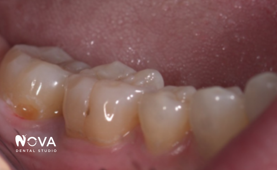 A close up of a person 's mouth with white teeth.