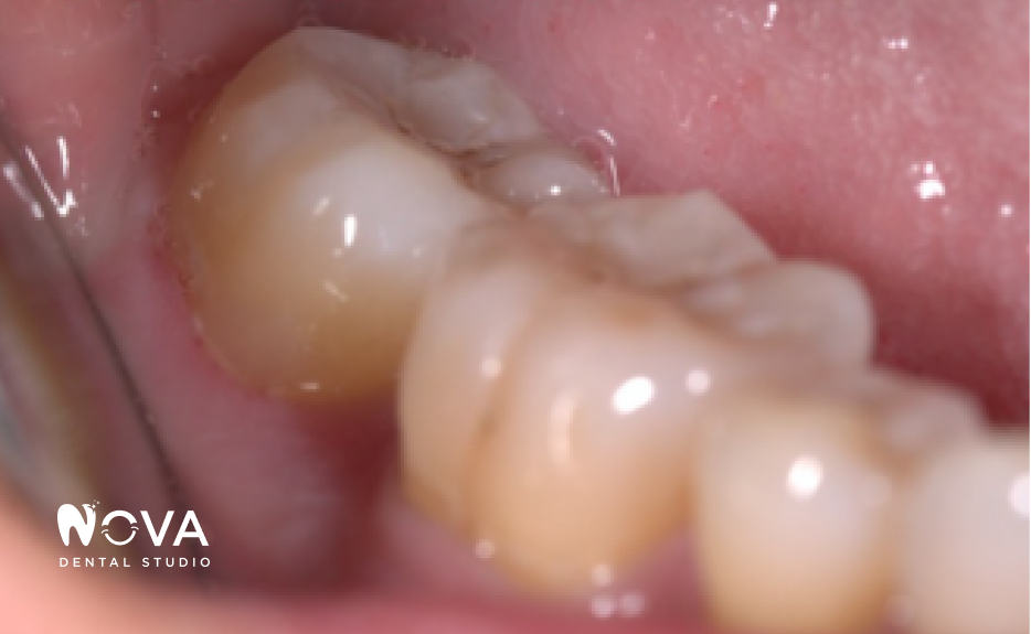 A close up of a woman 's smile with white teeth.