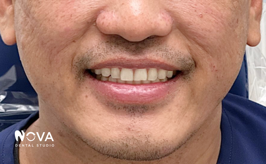 A close up of a person 's teeth and mouth.