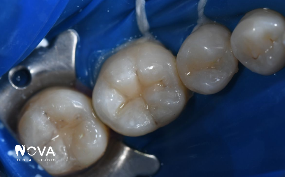 A close up of a woman 's smile with white teeth.