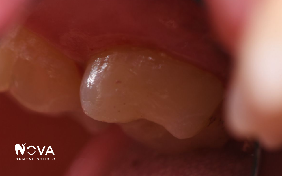 A close up of a woman 's smile with white teeth.