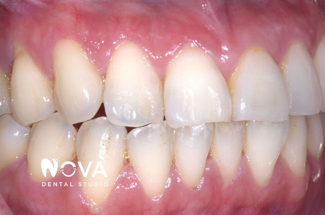 A close up of a person 's teeth and gums.