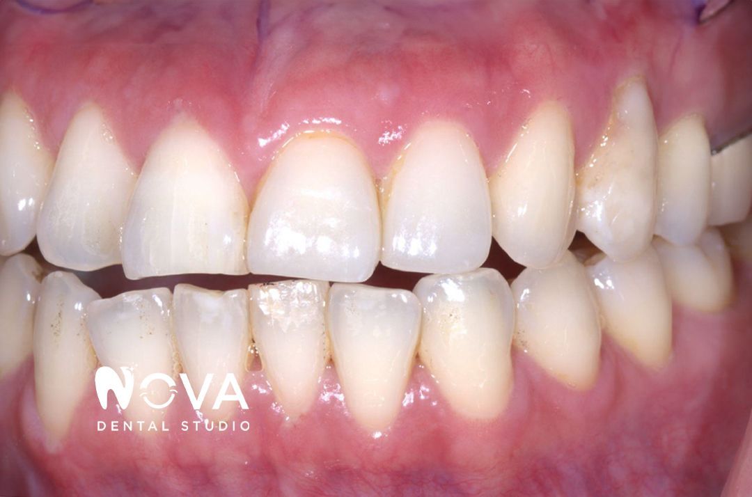 A close up of a person 's teeth with a broken tooth.