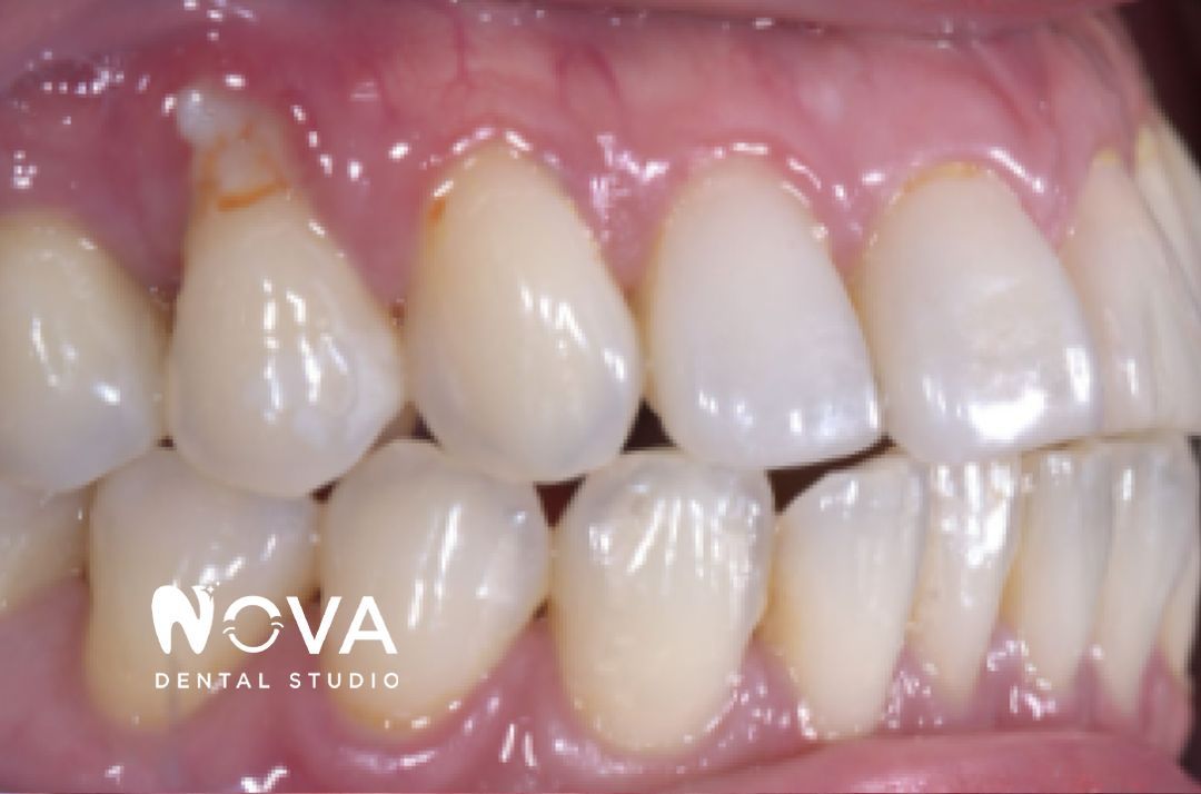 A close up of a person 's teeth from nova dental studio