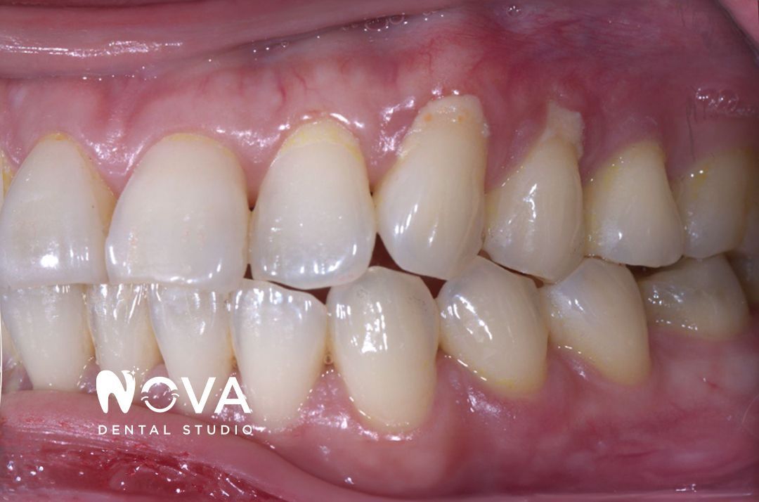 A close up of a person 's teeth with the word nova on the bottom