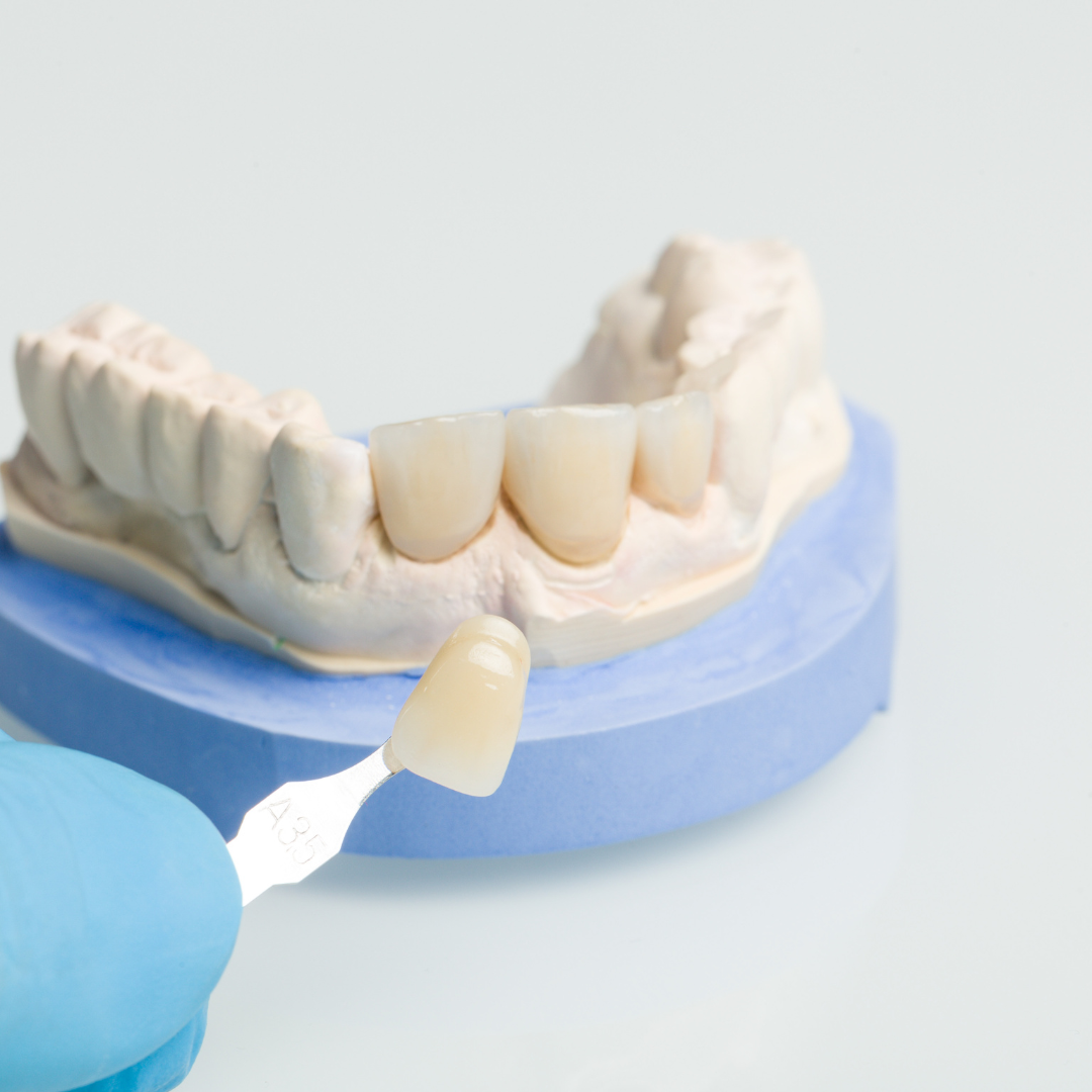 Dental mold with three porcelain crowns, a matching shade guide, held by a gloved hand.