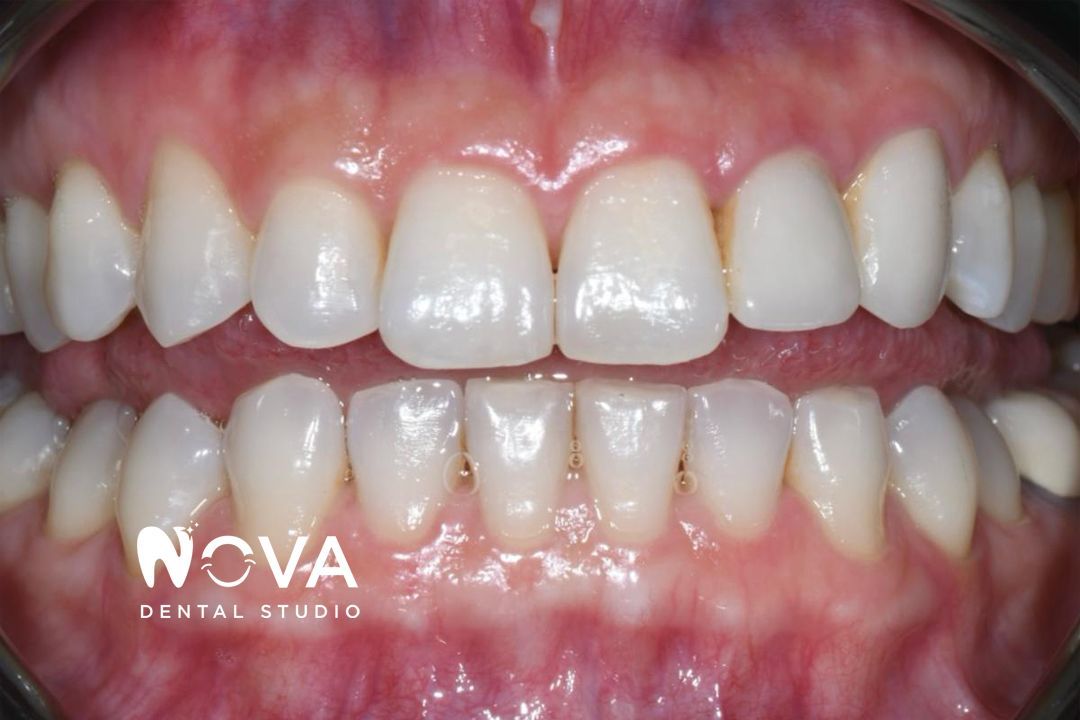 A close up of a person 's teeth with nova dental studio written on the bottom.