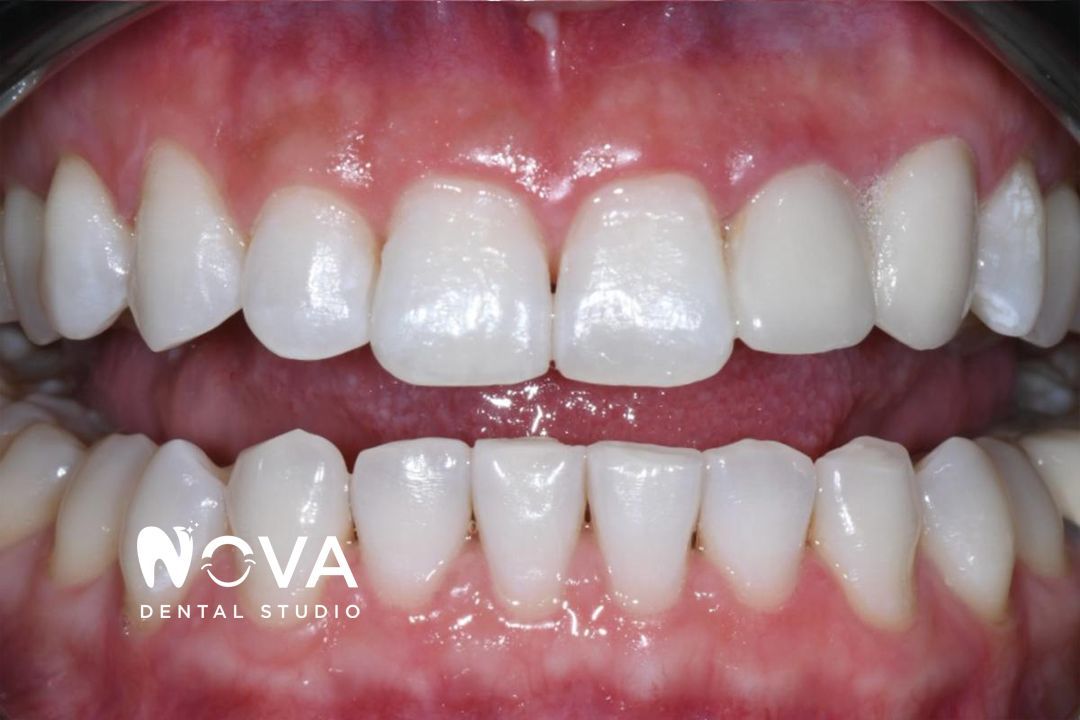 A close up of a person 's teeth from nova dental studio