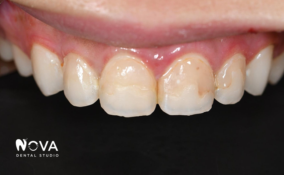 A close up of a person 's teeth and mouth.