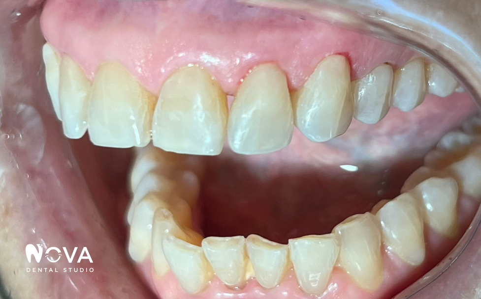 A close up of a woman 's smile with white teeth.