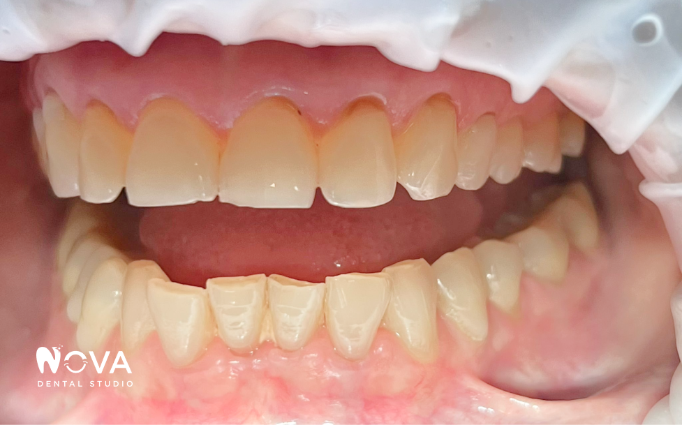 A close up of a woman 's mouth with white teeth and red lips.