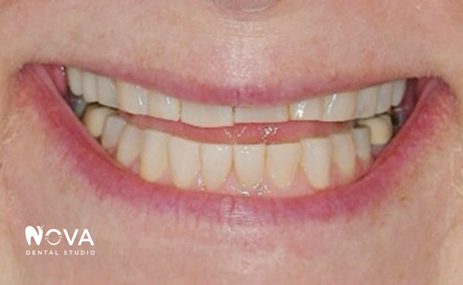 A close up of a person 's teeth with nova dental studio written on the bottom