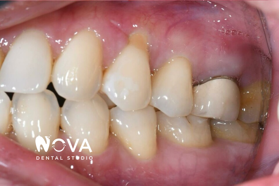 A close up of a person 's teeth with nova dental studio written on the bottom