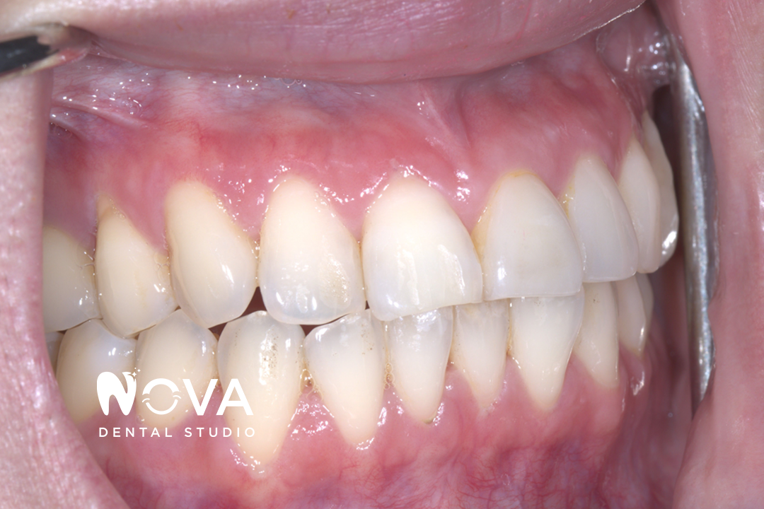 A close up of a person 's teeth from nova dental studio