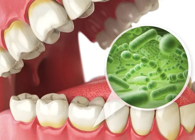 Close-up of teeth with yellowish stains and an inset showing green bacteria.