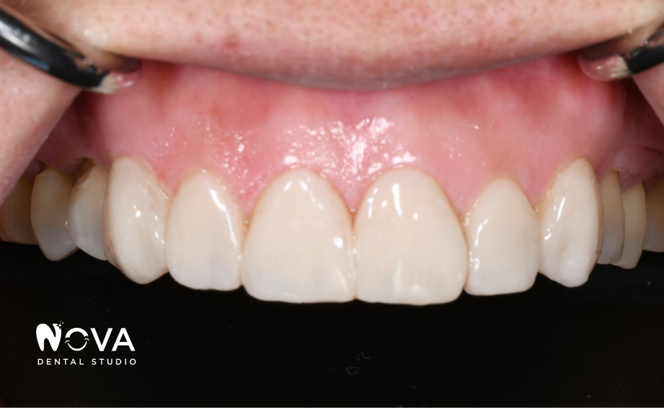 A close up of a person 's teeth from nova dental studio