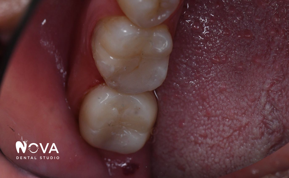 A close up of a woman 's smile with white teeth.