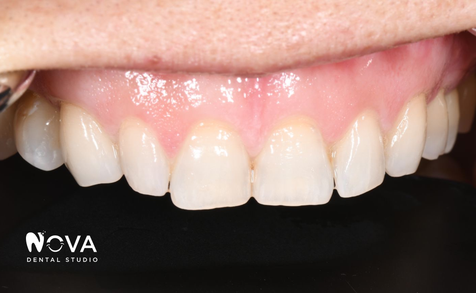 A close up of a person 's teeth and mouth.