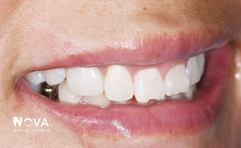 Close-up of a smiling mouth with white teeth and pink lips