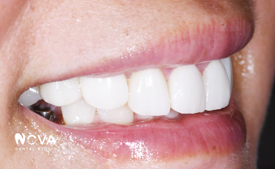 A close up of a woman 's smile with white teeth and pink lips.