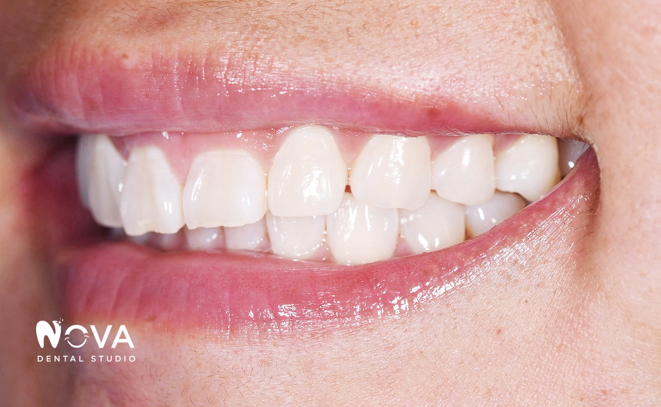 Close-up of a smiling mouth with clean white teeth and pink lips
