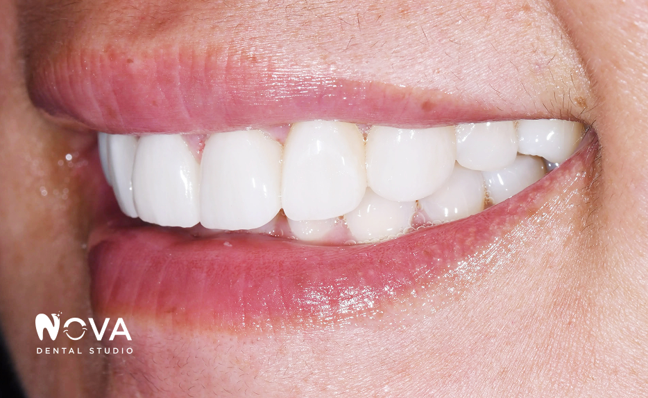 Close-up of a smiling mouth with bright white teeth and pink lips