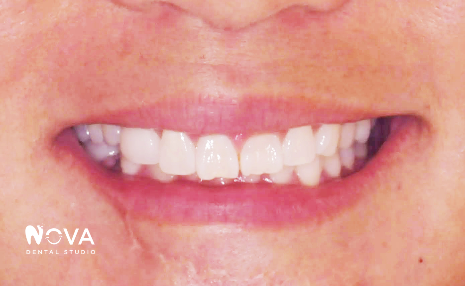 Close-up of a smiling mouth showing bright white teeth and pink lips