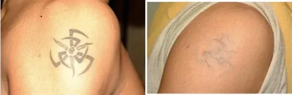 rimozione tatuaggi a Bologna