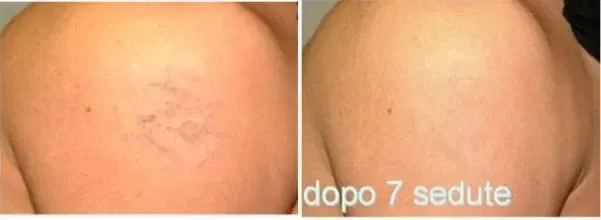 rimozione tatuaggi a Bologna con laser