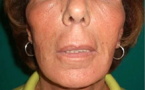 Filler viso a Bologna prima e dopo