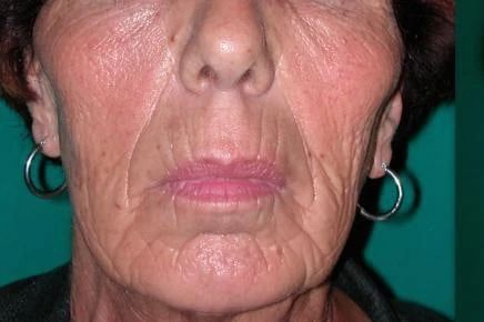 Trattamento filler viso a Bologna prima e dopo