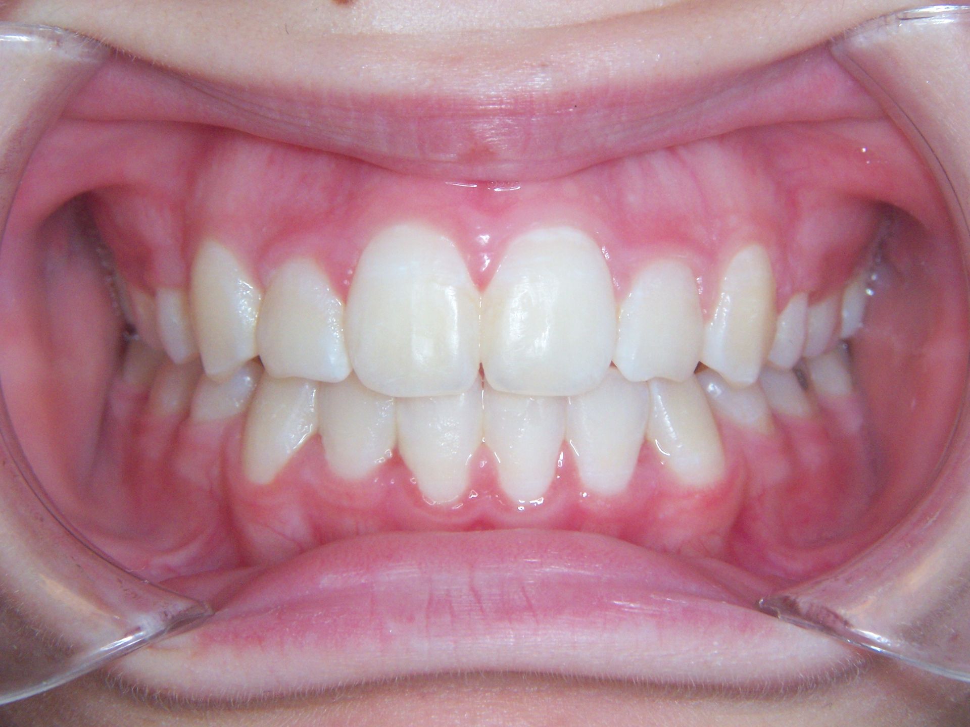 A close up of a person 's teeth and mouth.