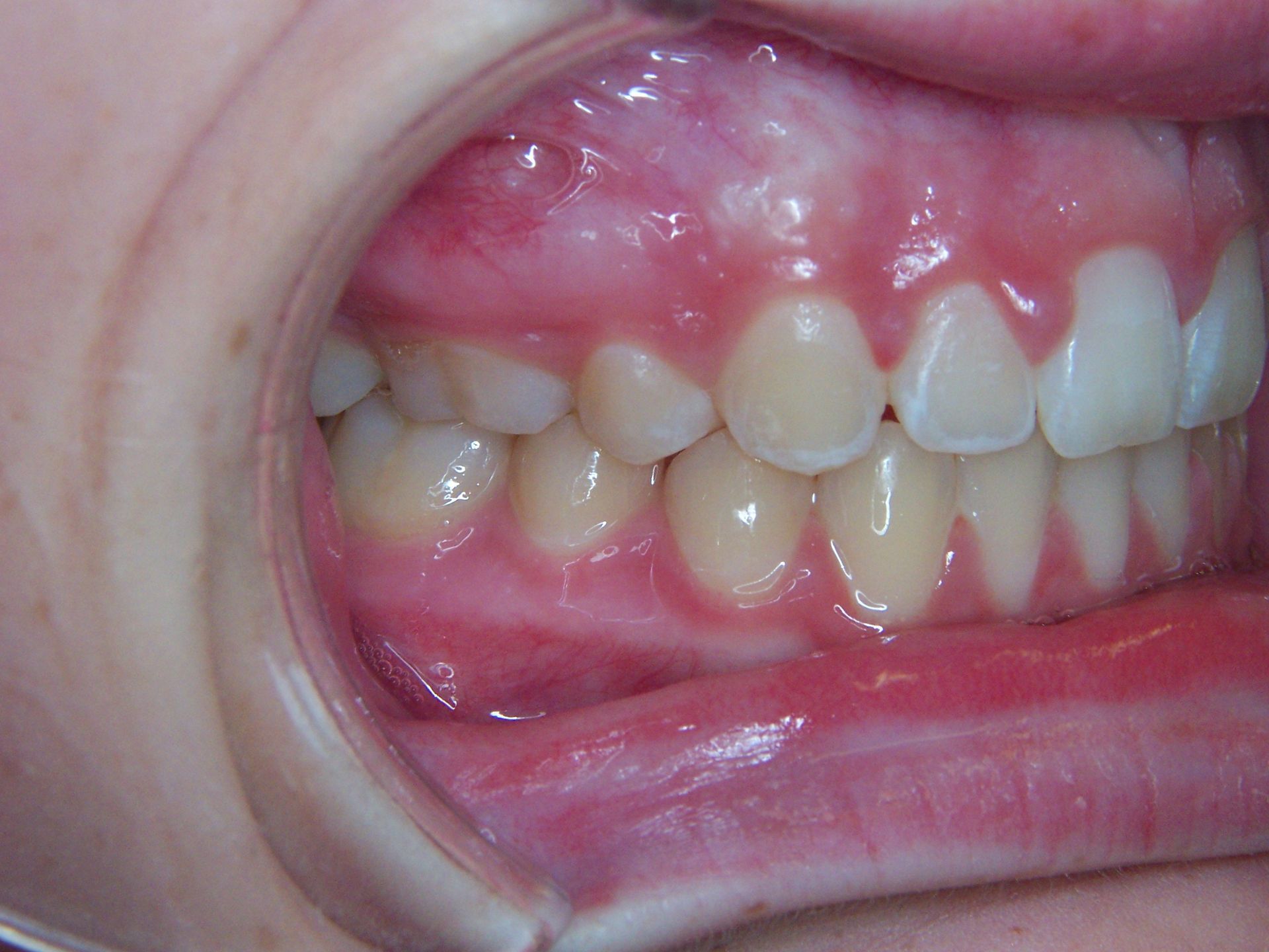 A close up of a person 's teeth and mouth.