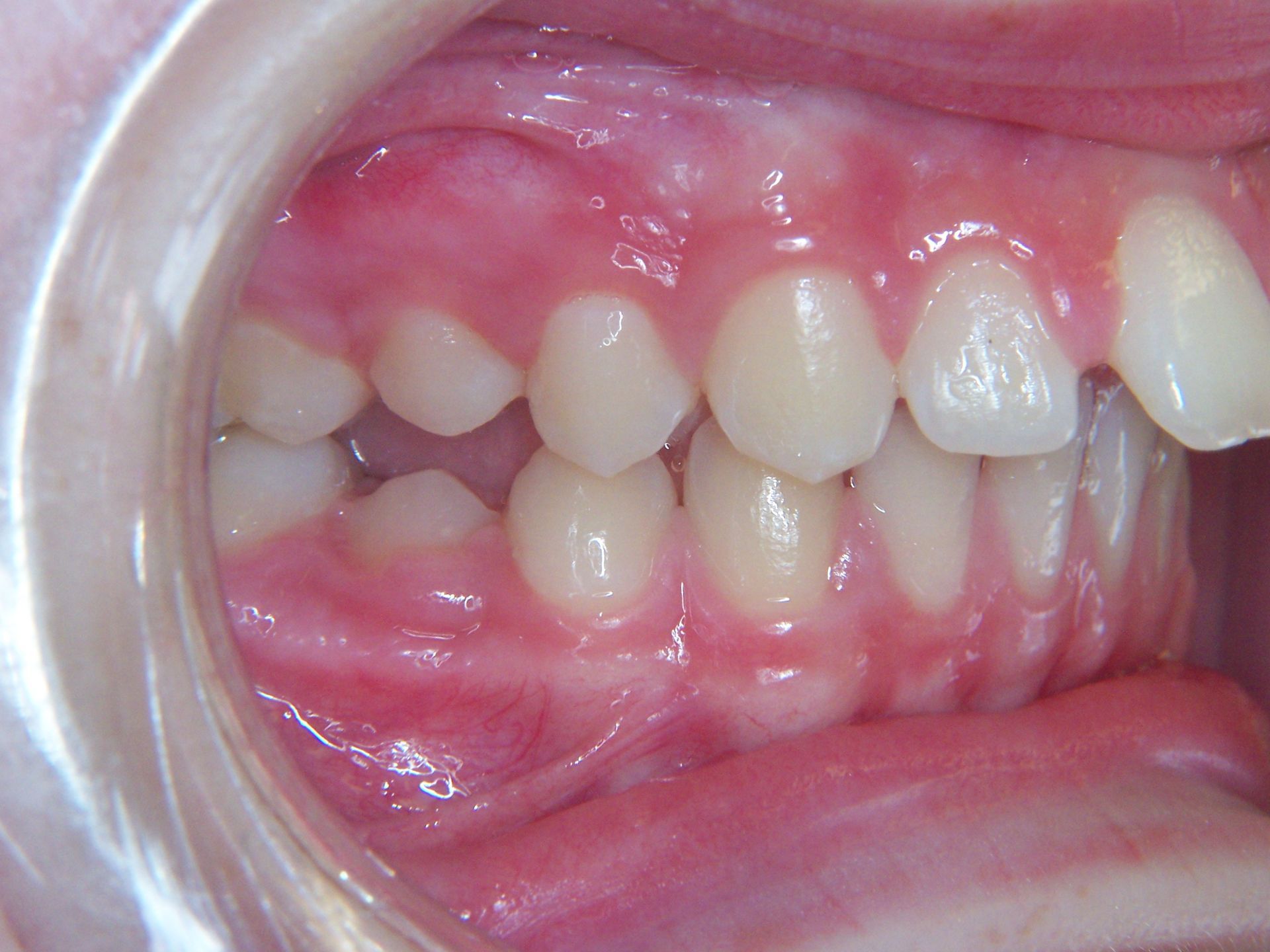 A close up of a person 's teeth and mouth.