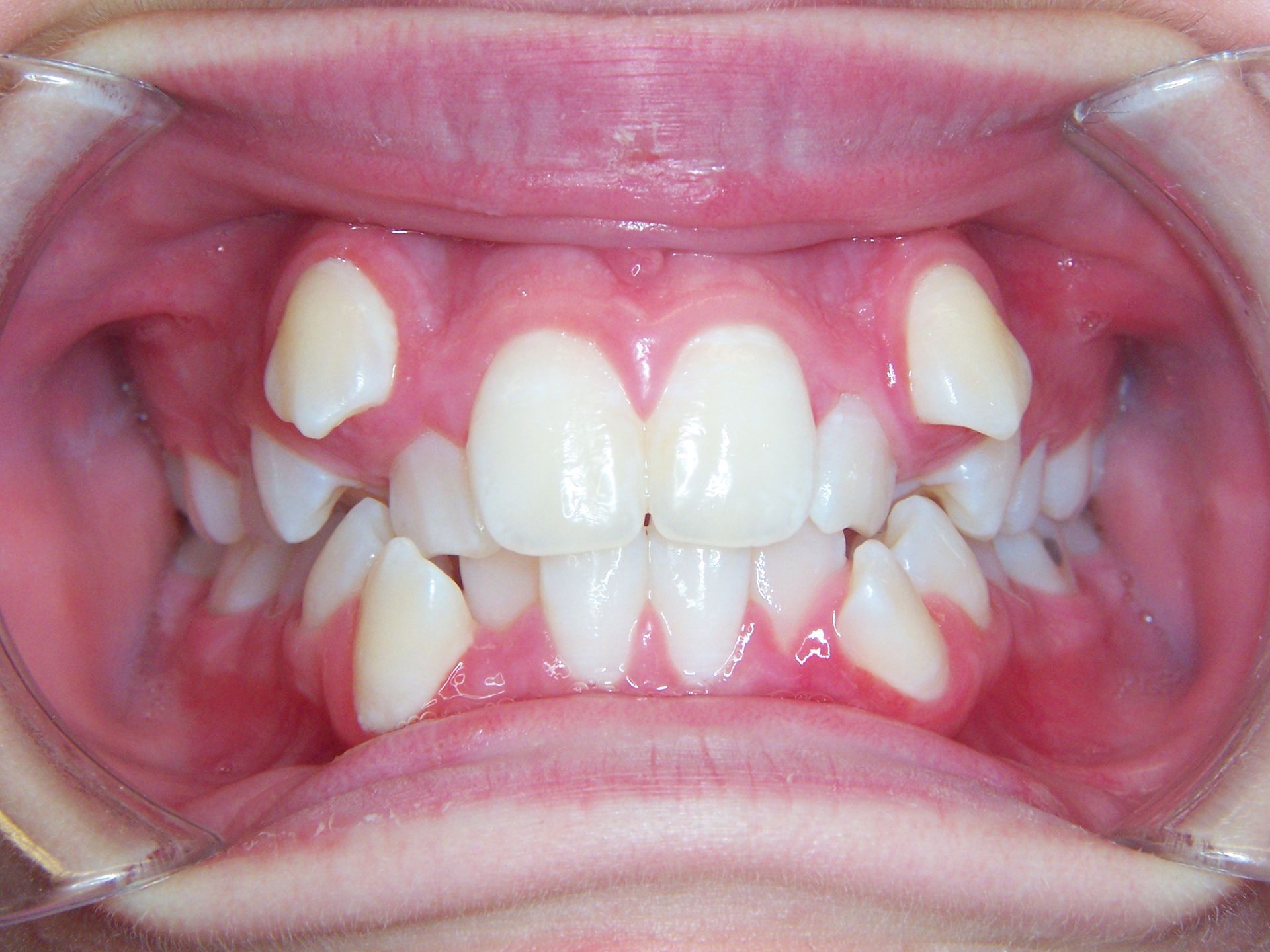 A close up of a person 's teeth and mouth.
