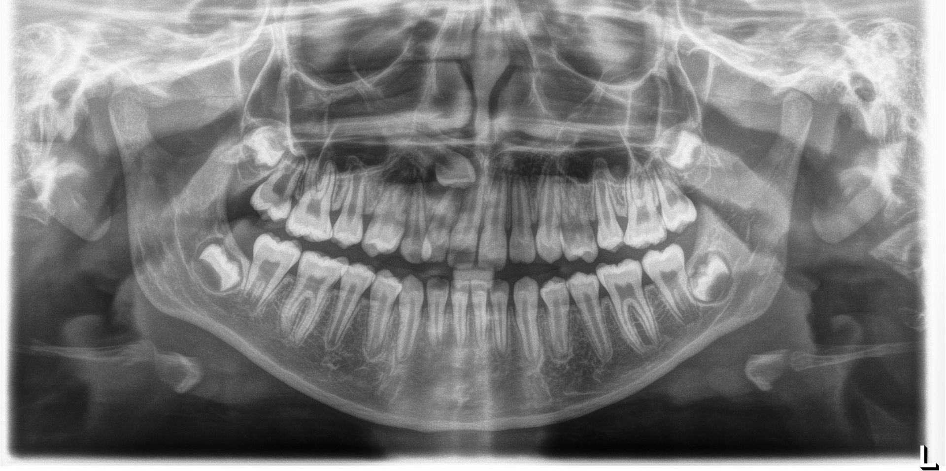 A close up of a person 's teeth and mouth.